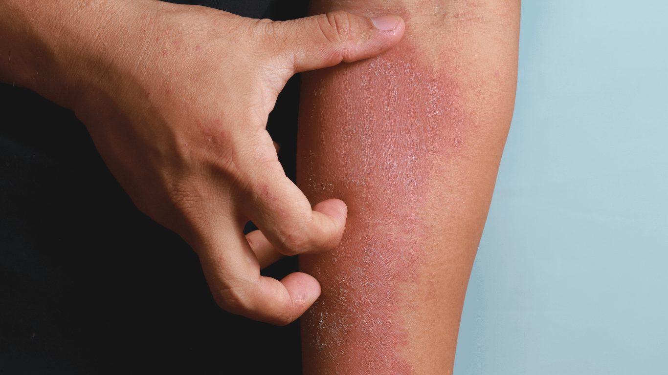CBD and eczema